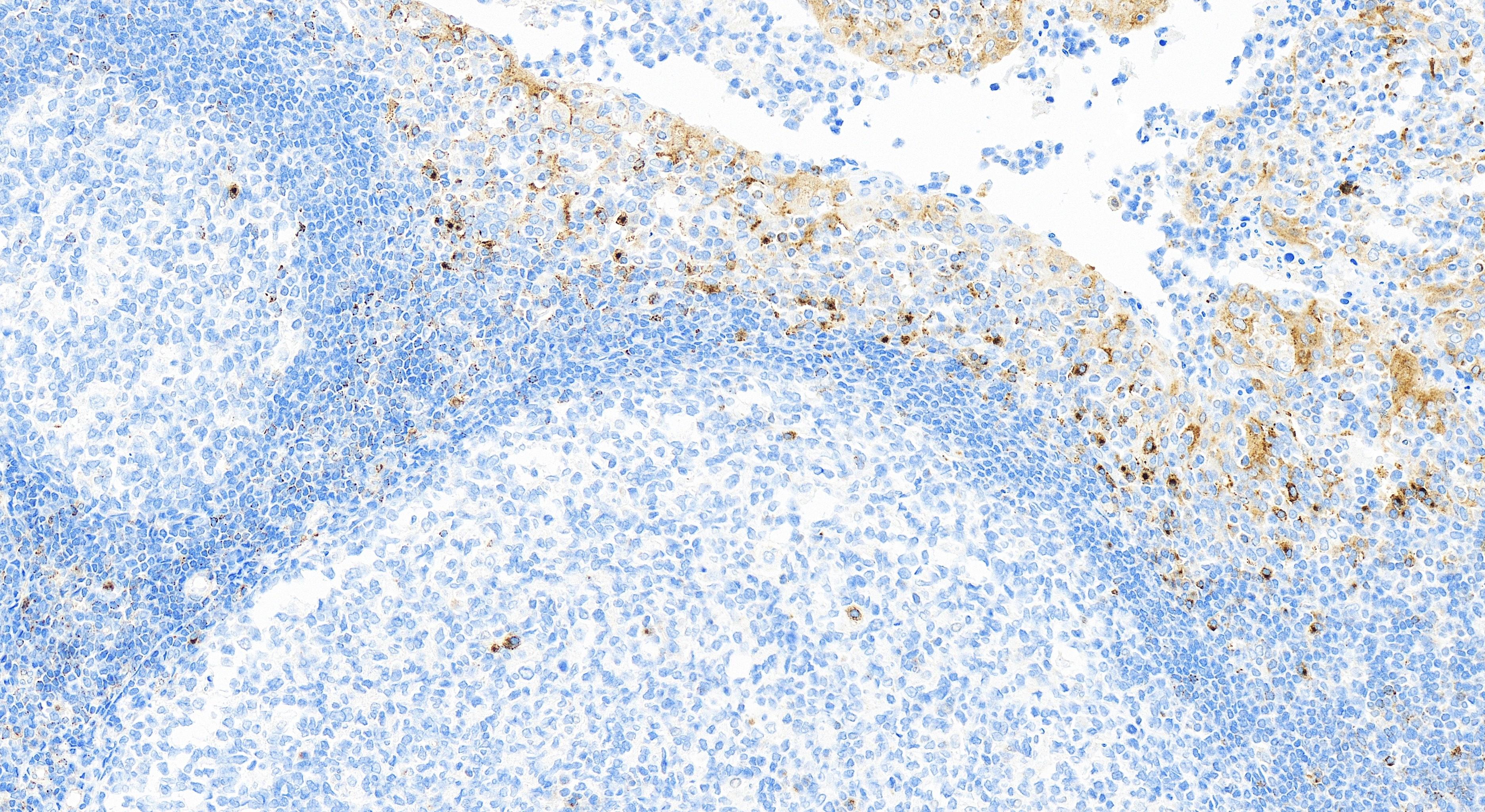 Immunohistochemistry (IHC) staining of human tonsillitis tissue using VISTA Recombinant antibody (83919-4-RR)