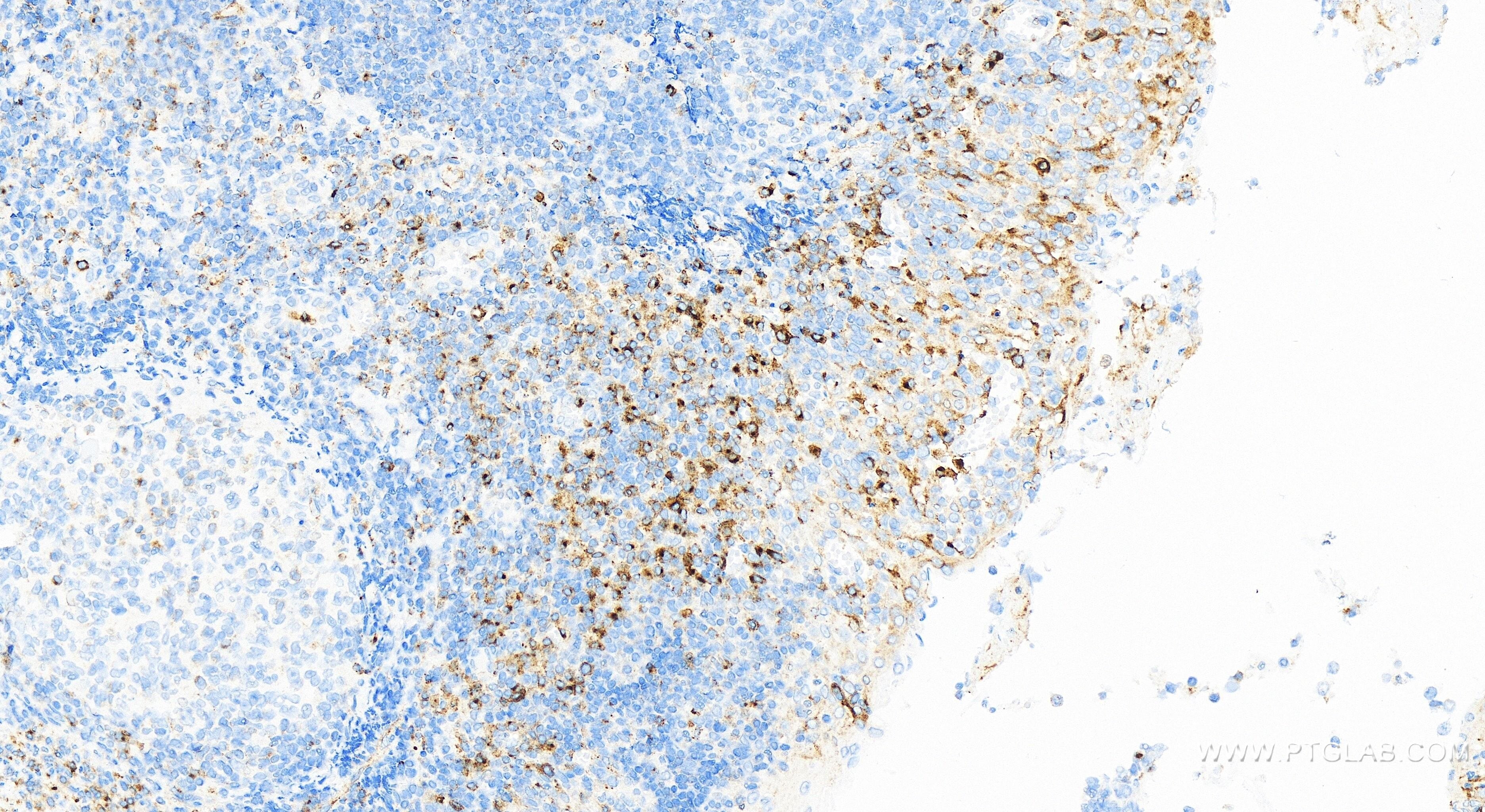 Immunohistochemistry (IHC) staining of human tonsillitis tissue using VISTA Recombinant antibody (83919-4-RR)