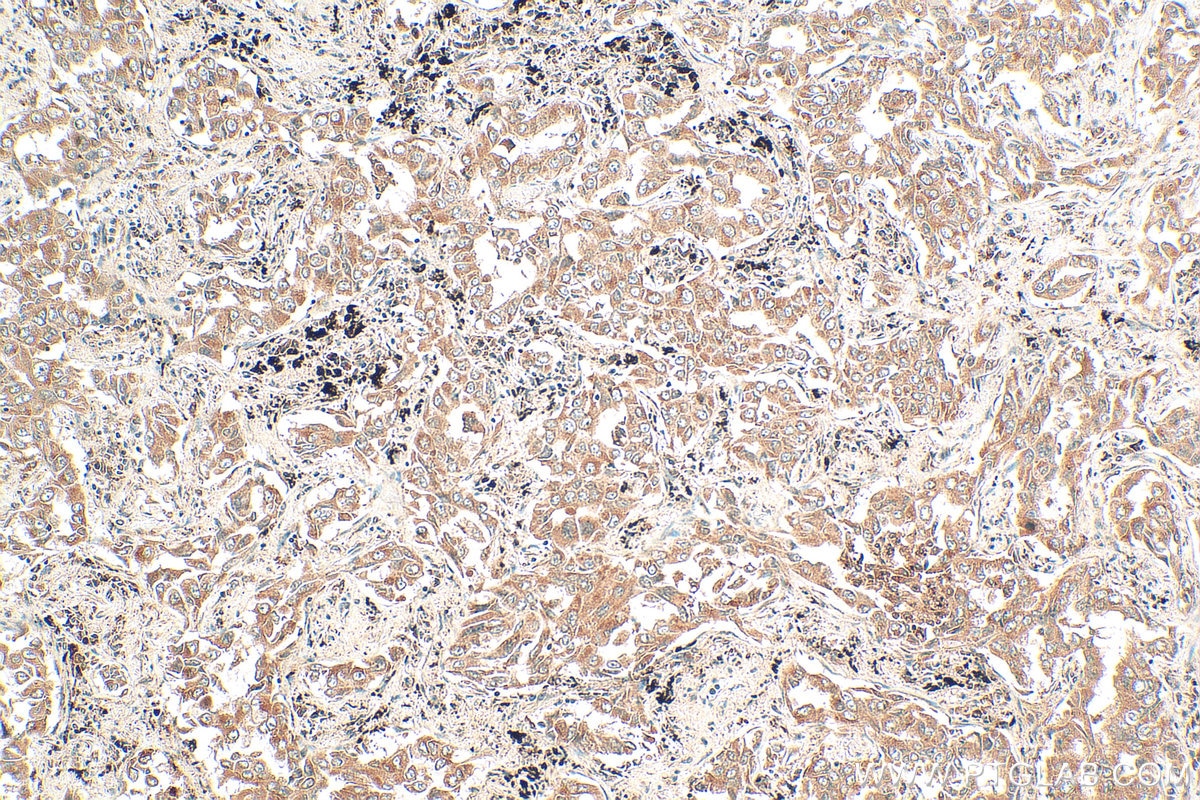 Immunohistochemistry (IHC) staining of human lung cancer tissue using VLDLR Polyclonal antibody (19493-1-AP)