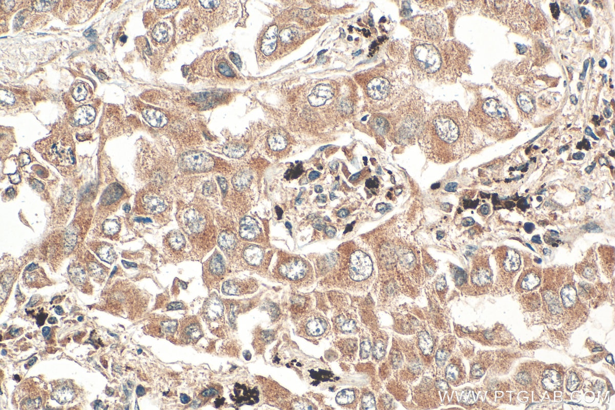 Immunohistochemistry (IHC) staining of human lung cancer tissue using VLDLR Polyclonal antibody (19493-1-AP)