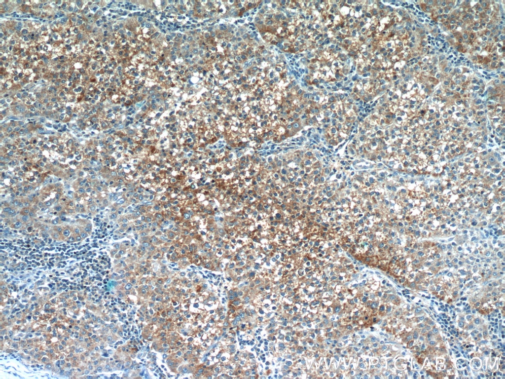 Immunohistochemistry (IHC) staining of human liver cancer tissue using VN1R3 Polyclonal antibody (24659-1-AP)