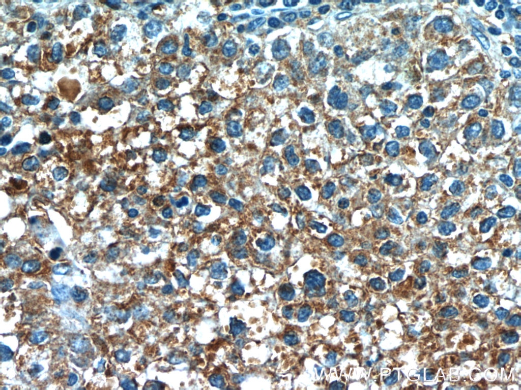 Immunohistochemistry (IHC) staining of human liver cancer tissue using VN1R3 Polyclonal antibody (24659-1-AP)