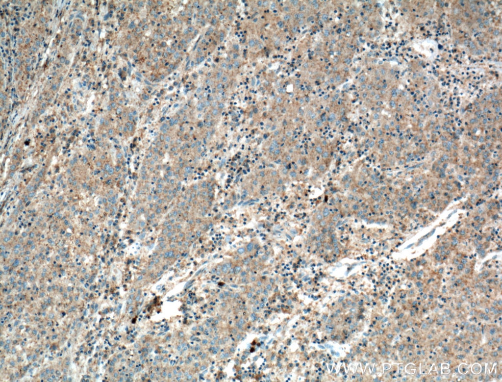 Immunohistochemistry (IHC) staining of human liver cancer tissue using VN1R3 Polyclonal antibody (24659-1-AP)