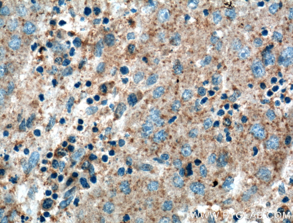 Immunohistochemistry (IHC) staining of human liver cancer tissue using VN1R3 Polyclonal antibody (24659-1-AP)