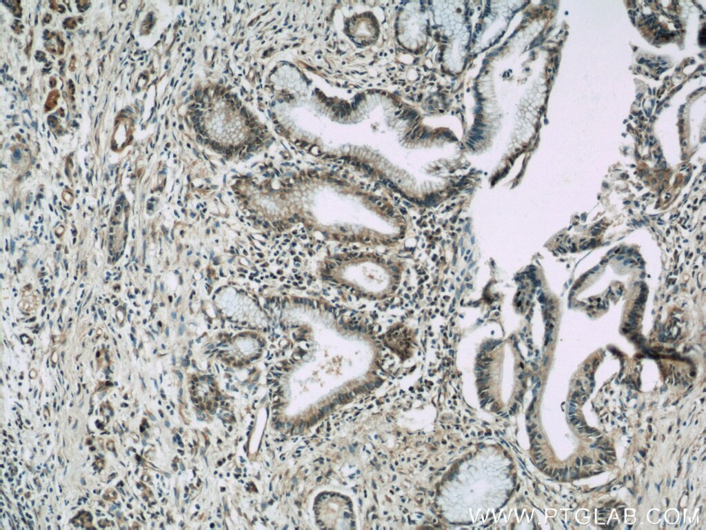 Immunohistochemistry (IHC) staining of human pancreas cancer tissue using VNN1 Polyclonal antibody (21745-1-AP)