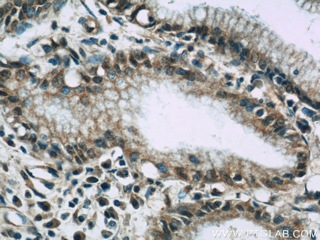 Immunohistochemistry (IHC) staining of human pancreas cancer tissue using VNN1 Polyclonal antibody (21745-1-AP)