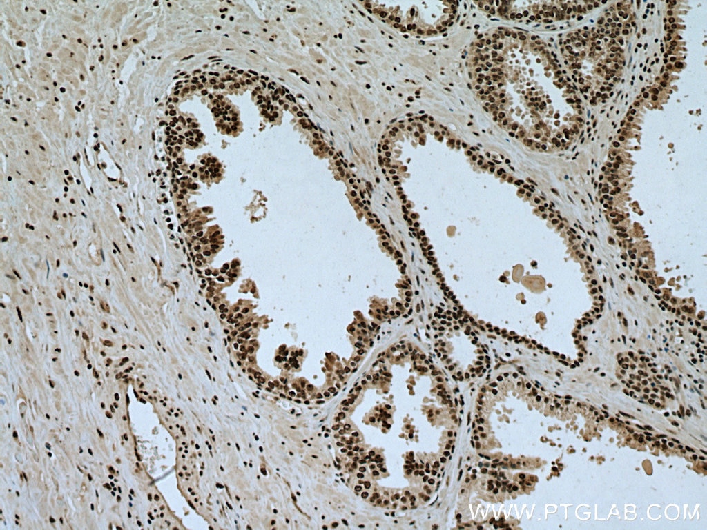 Immunohistochemistry (IHC) staining of human prostate cancer tissue using VPRBP Polyclonal antibody (11612-1-AP)