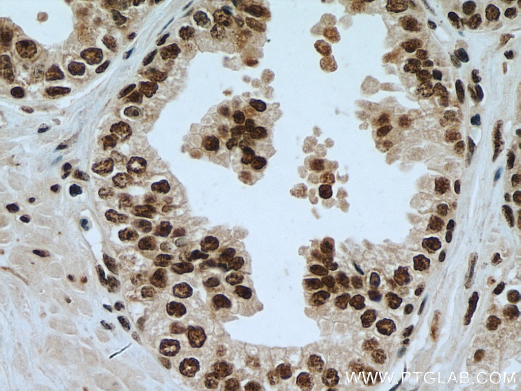 IHC staining of human prostate cancer using 11612-1-AP