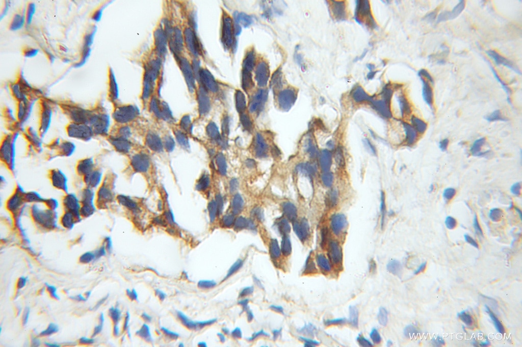 Immunohistochemistry (IHC) staining of human prostate cancer tissue using VPRBP Polyclonal antibody (11612-1-AP)