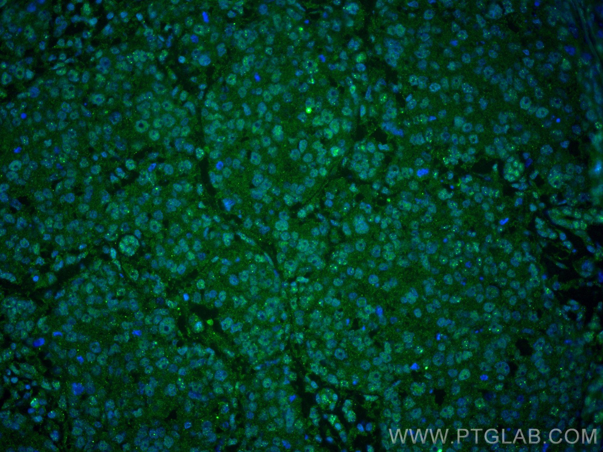 Immunofluorescence (IF) / fluorescent staining of human breast cancer tissue using VPRBP Monoclonal antibody (66392-1-Ig)
