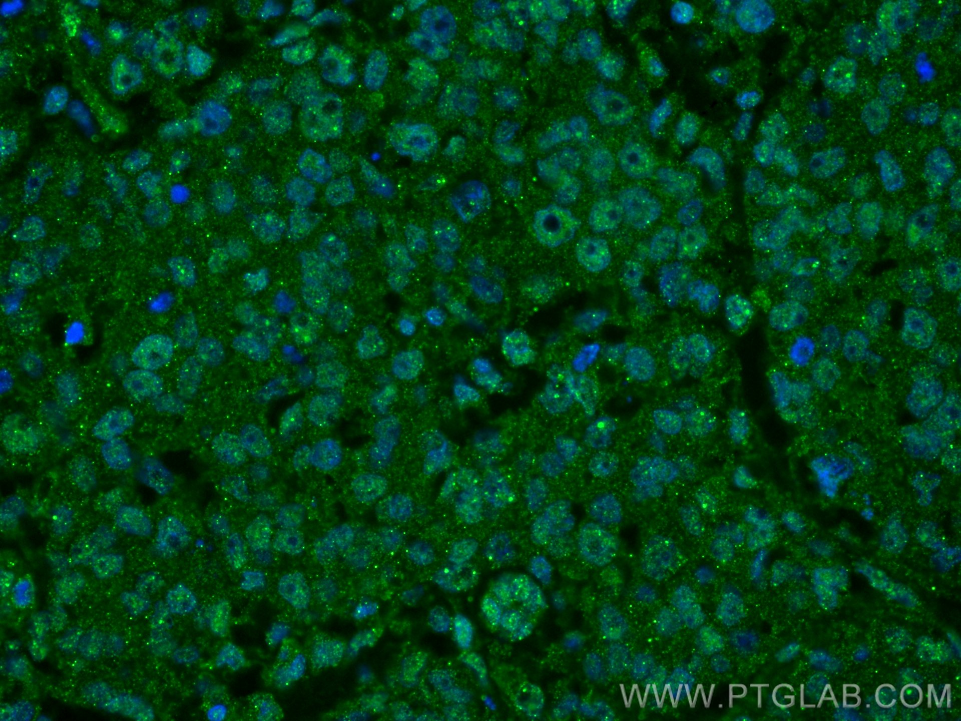 IF Staining of human breast cancer using 66392-1-Ig