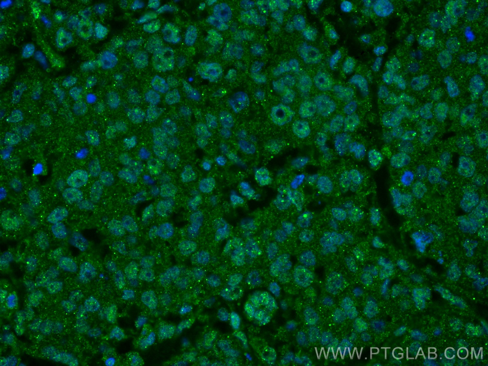 Immunofluorescence (IF) / fluorescent staining of human breast cancer tissue using VPRBP Monoclonal antibody (66392-1-Ig)