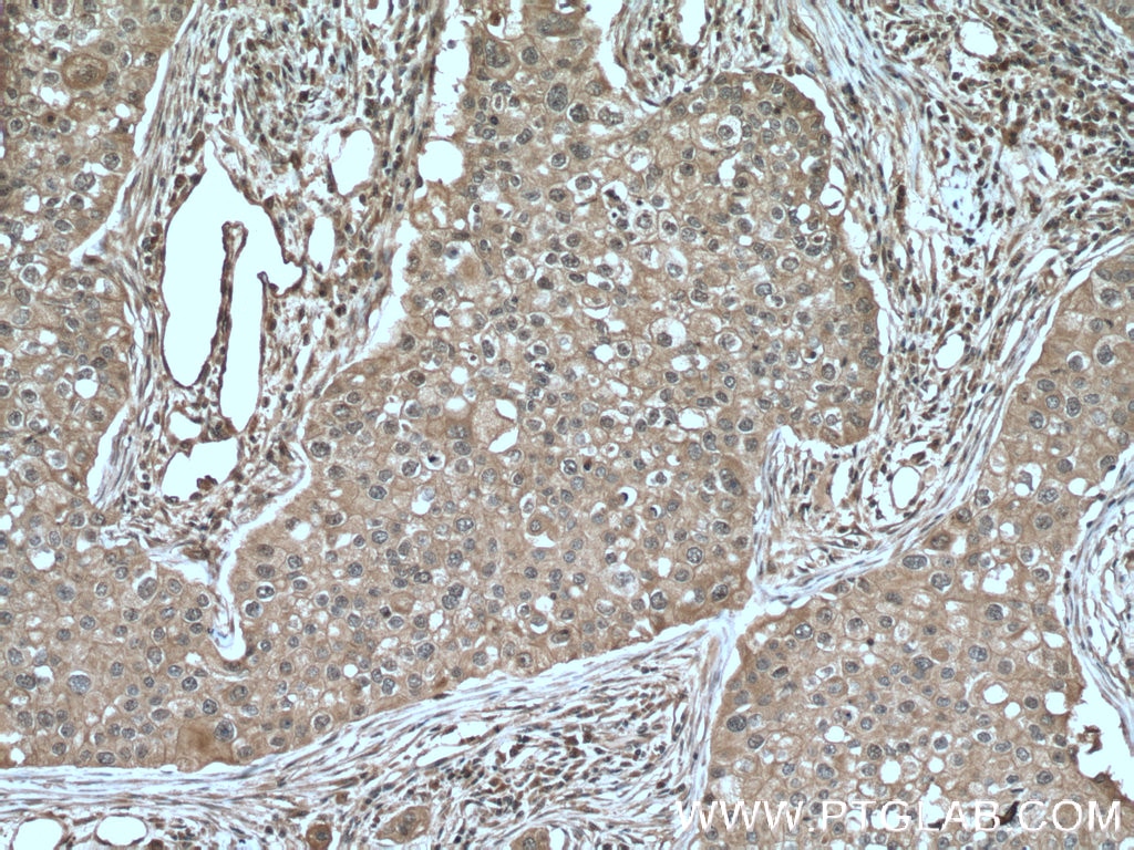 IHC staining of human breast cancer using 66392-1-Ig