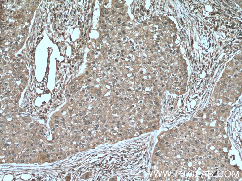 IHC staining of human breast cancer using 66392-1-Ig