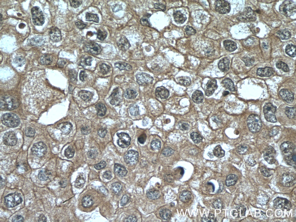 Immunohistochemistry (IHC) staining of human breast cancer tissue using VPRBP Monoclonal antibody (66392-1-Ig)