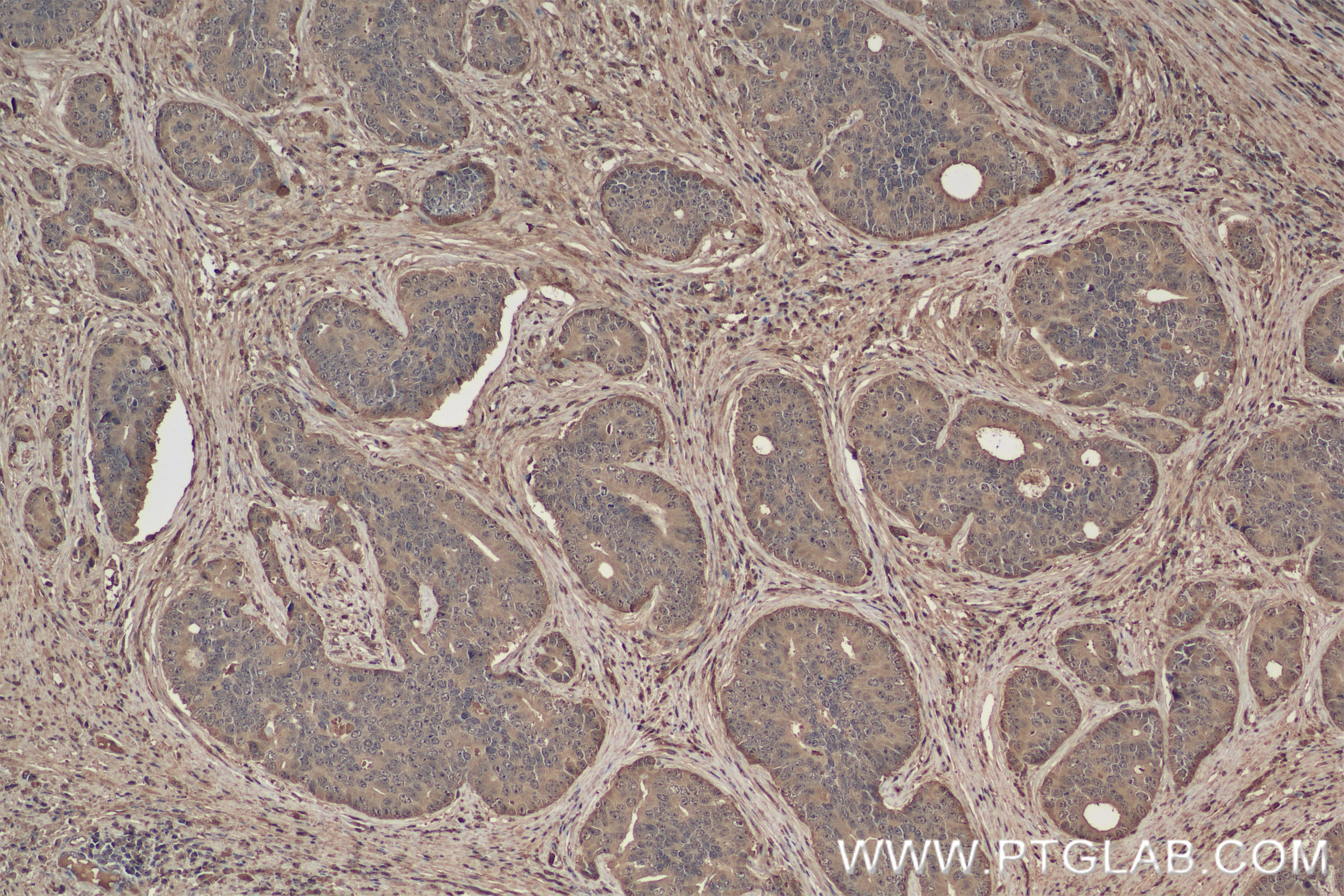 Immunohistochemistry (IHC) staining of human prostate cancer tissue using VPRBP Recombinant antibody (83901-5-RR)