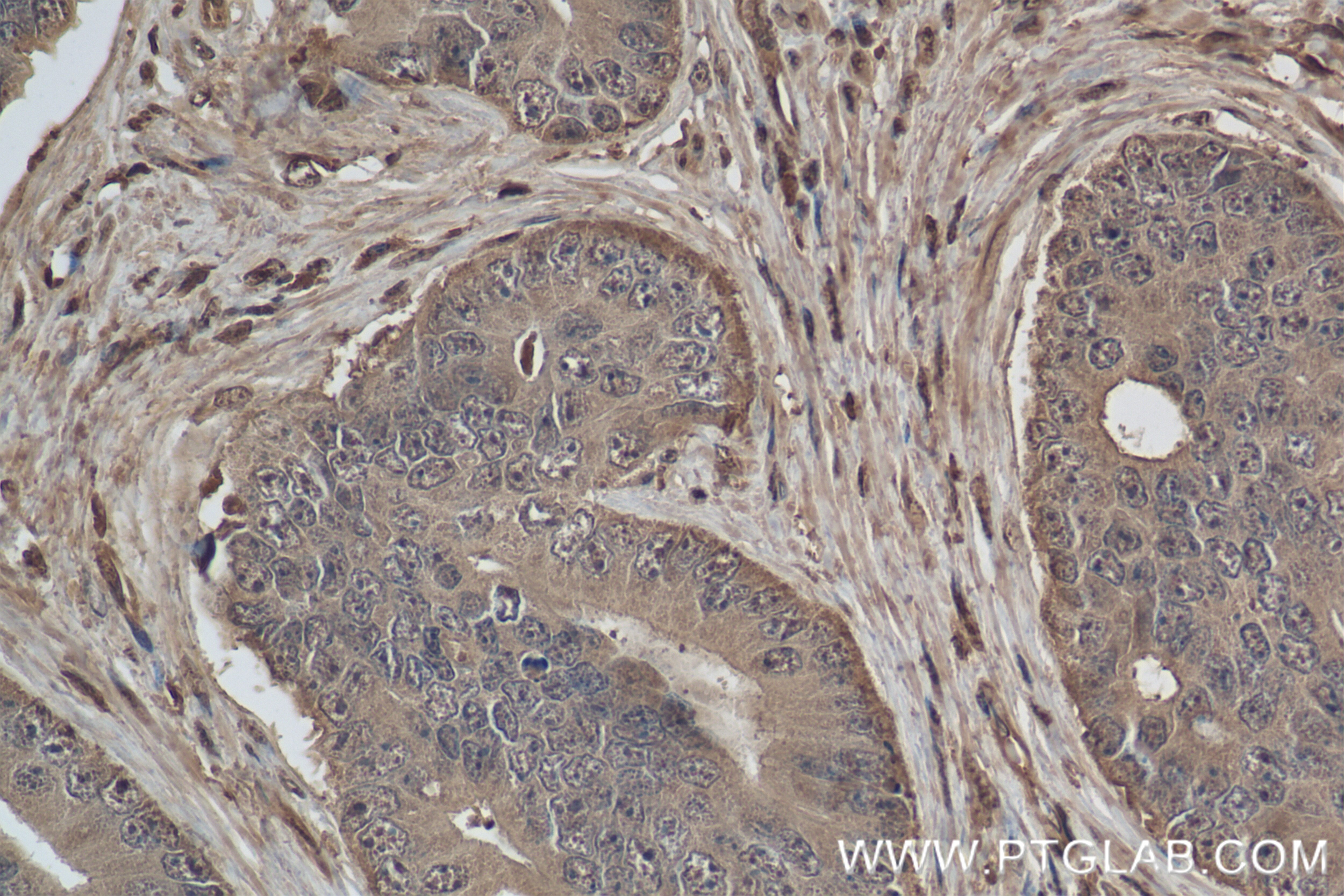Immunohistochemistry (IHC) staining of human prostate cancer tissue using VPRBP Recombinant antibody (83901-5-RR)
