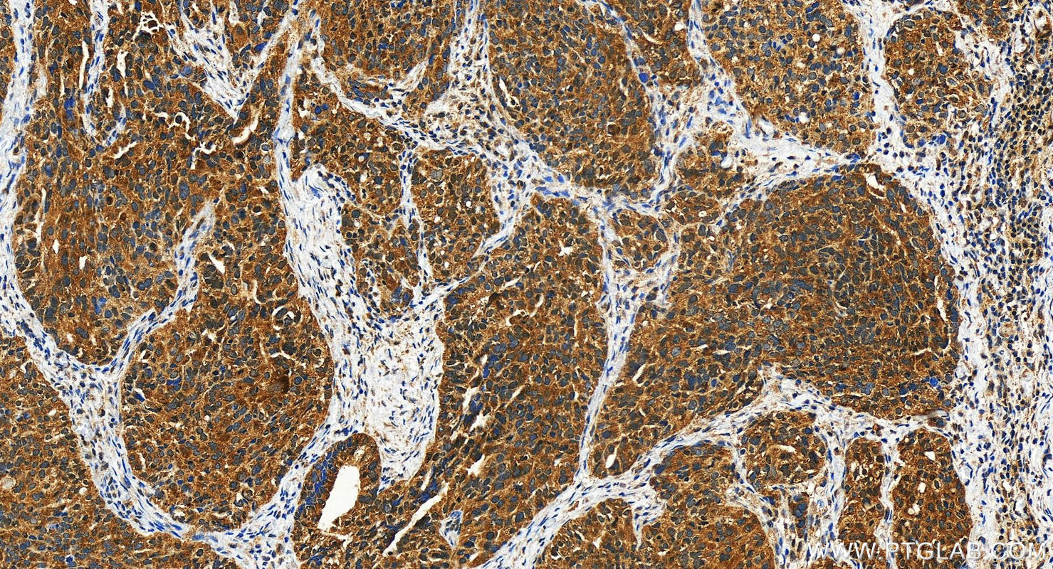 Immunohistochemistry (IHC) staining of human ovary cancer tissue using VPS13D Polyclonal antibody (29387-1-AP)
