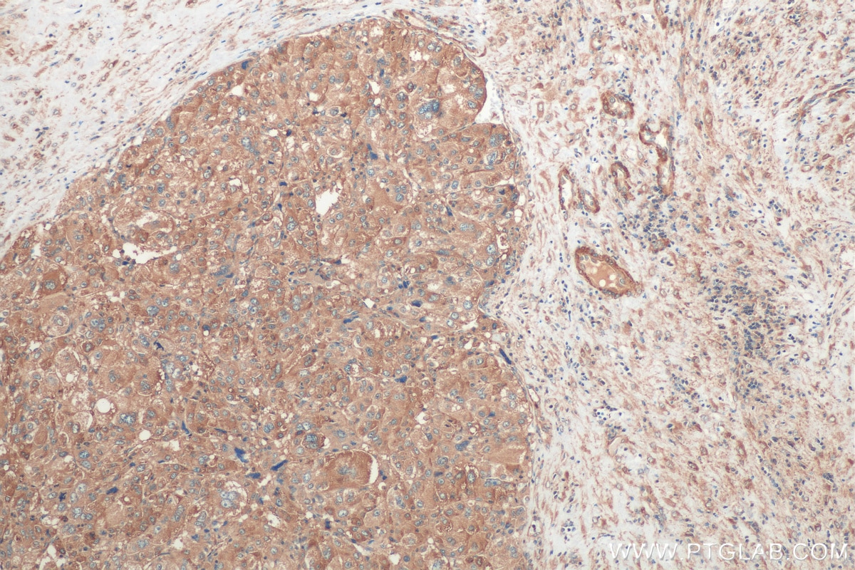 Immunohistochemistry (IHC) staining of human liver cancer tissue using VPS16 Polyclonal antibody (17776-1-AP)