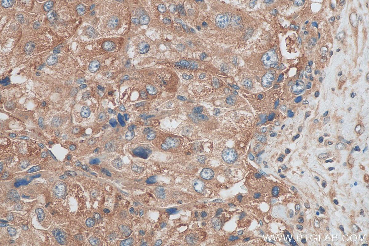 Immunohistochemistry (IHC) staining of human liver cancer tissue using VPS16 Polyclonal antibody (17776-1-AP)