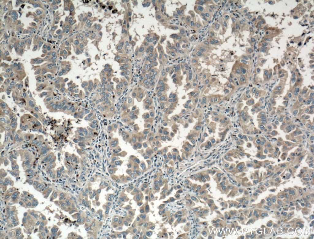 Immunohistochemistry (IHC) staining of human lung cancer tissue using VPS18 Polyclonal antibody (10901-1-AP)