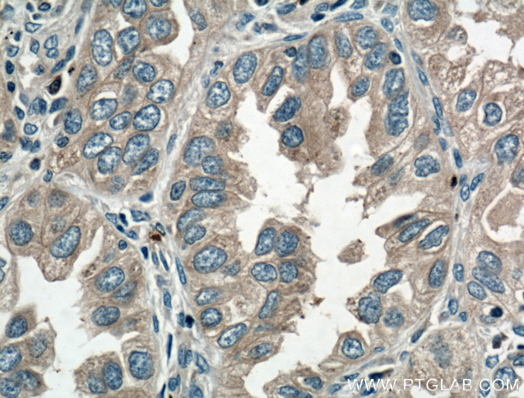 Immunohistochemistry (IHC) staining of human lung cancer tissue using VPS18 Polyclonal antibody (10901-1-AP)