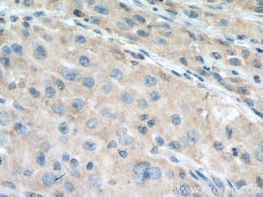 Immunohistochemistry (IHC) staining of human liver cancer tissue using VPS18 Monoclonal antibody (67590-1-Ig)