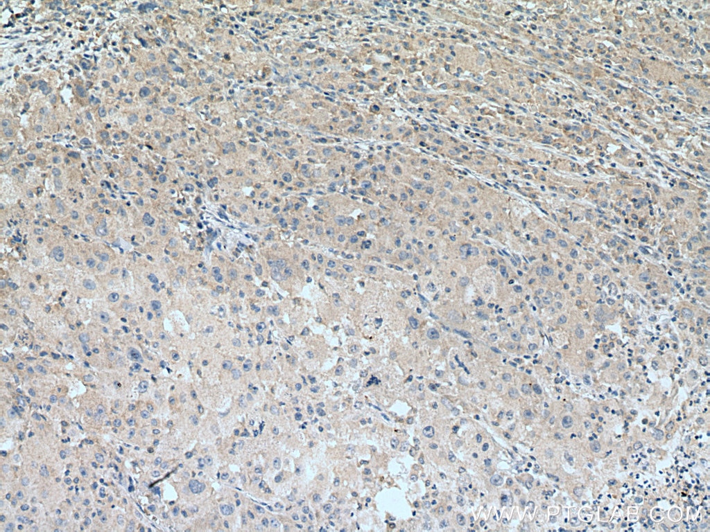 Immunohistochemistry (IHC) staining of human liver cancer tissue using VPS18 Monoclonal antibody (67590-1-Ig)