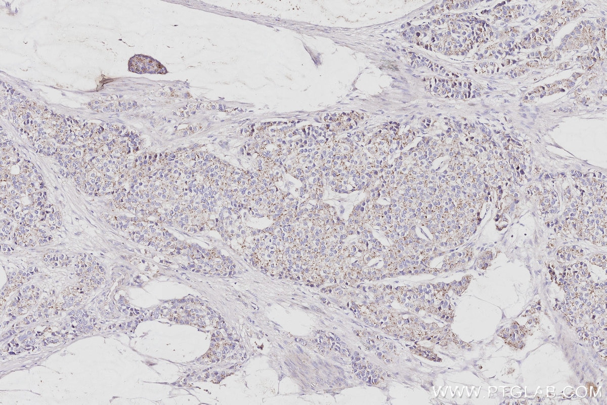 IHC staining of human stomach cancer using 15472-1-AP Immunohistochemistry (IHC) staining of human stomach cancer tissue using VPS24 Polyclonal antibody (15472-1-AP)