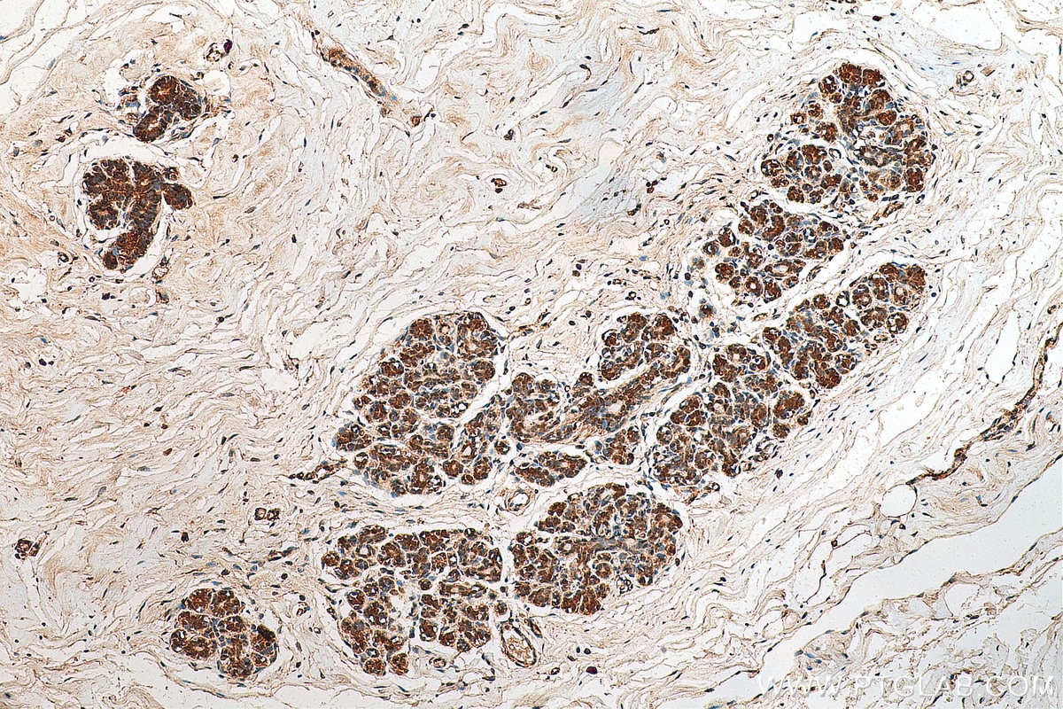 Immunohistochemistry (IHC) staining of human breast cancer tissue using VPS25 Polyclonal antibody (15669-1-AP)