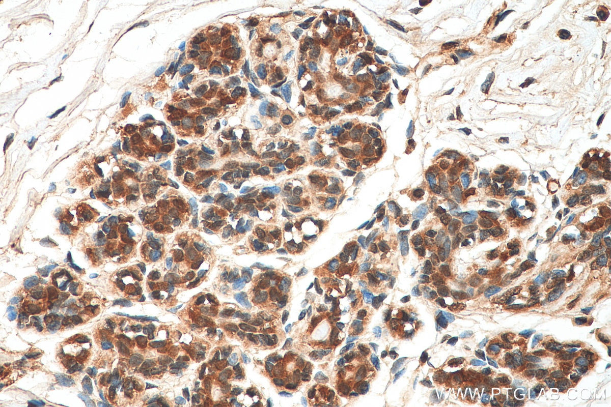 Immunohistochemistry (IHC) staining of human breast cancer tissue using VPS25 Polyclonal antibody (15669-1-AP)