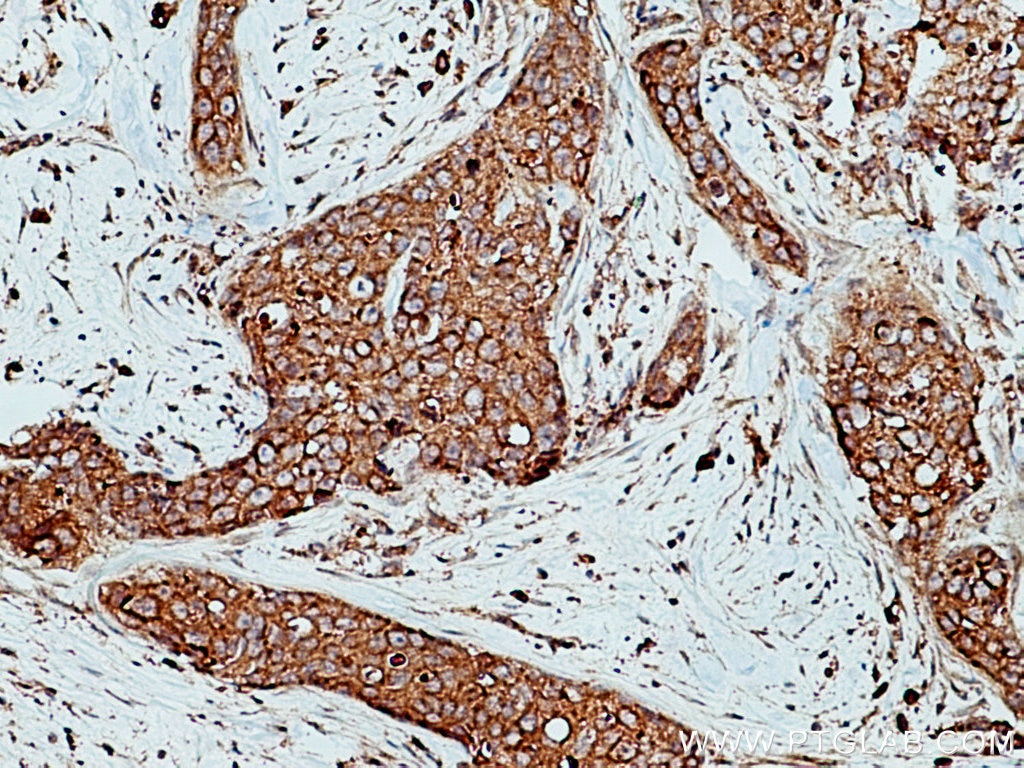 Immunohistochemistry (IHC) staining of human breast cancer tissue using VPS26A Polyclonal antibody (12804-1-AP)