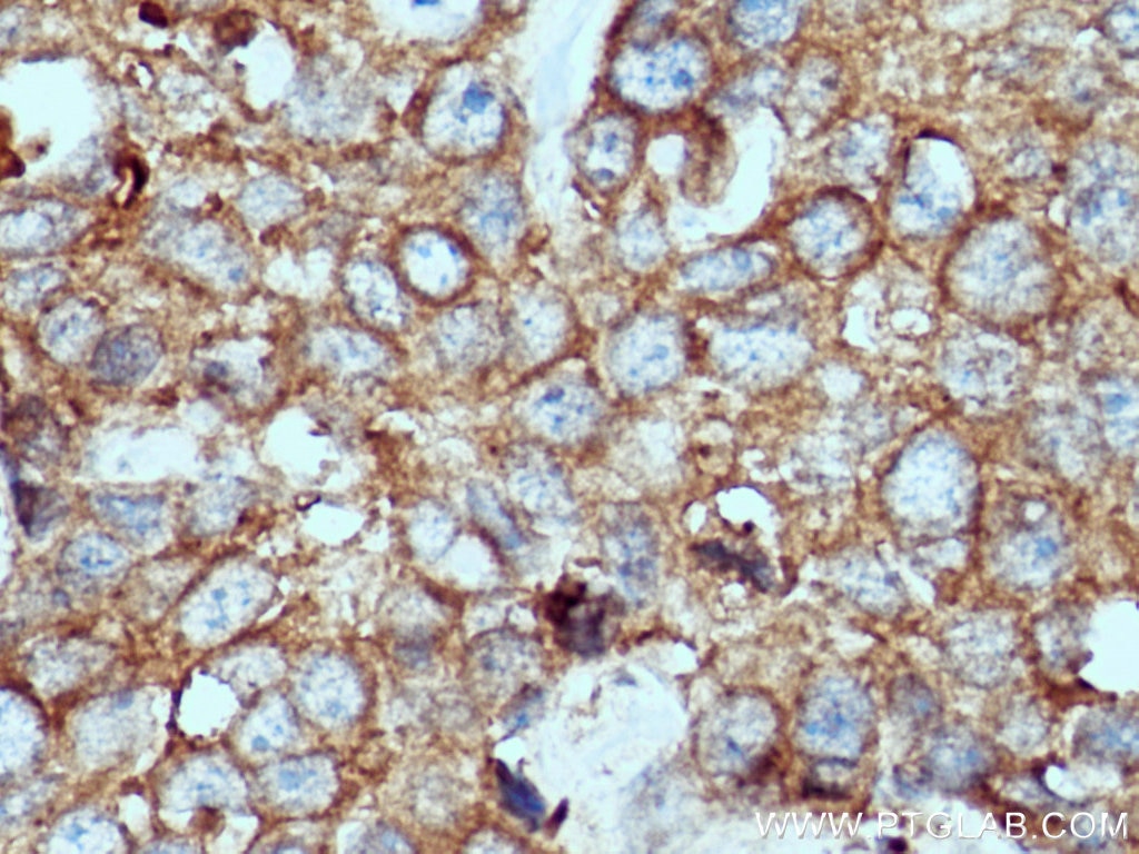 IHC staining of human breast cancer using 12804-1-AP