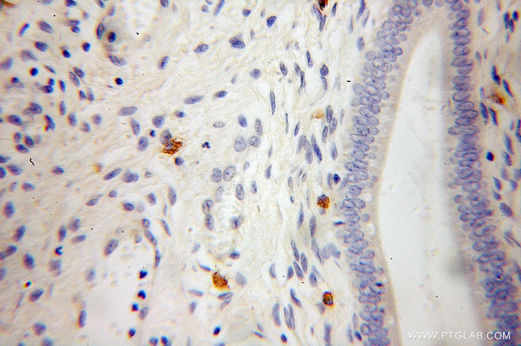 IHC staining of human cervical cancer using 12804-1-AP