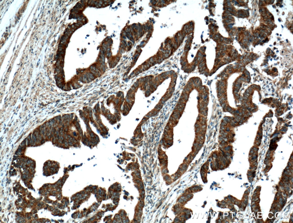 Immunohistochemistry (IHC) staining of human colon cancer tissue using VPS33B Polyclonal antibody (12195-1-AP)