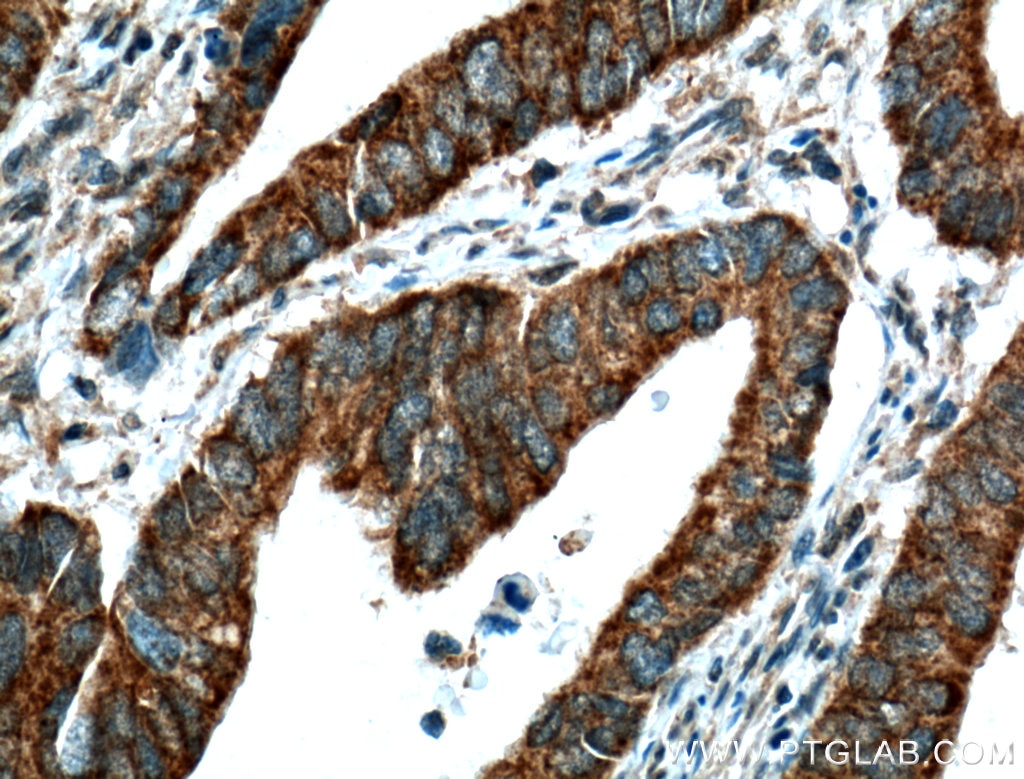 Immunohistochemistry (IHC) staining of human colon cancer tissue using VPS33B Polyclonal antibody (12195-1-AP)