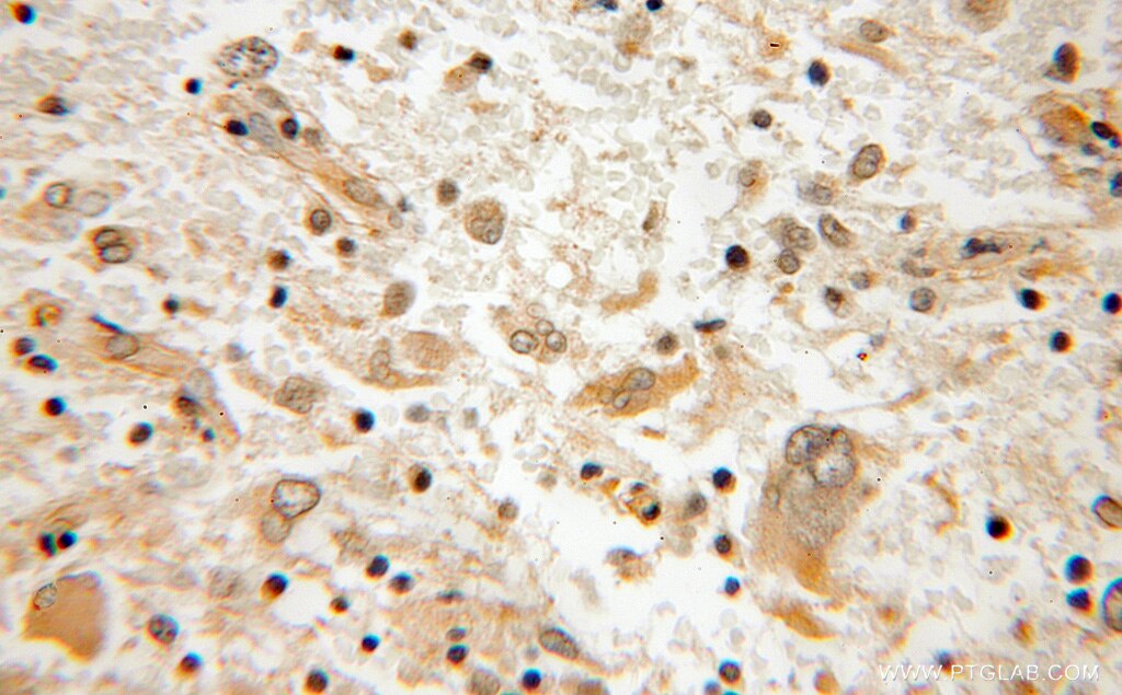 IHC staining of human medulloblastoma using 12195-1-AP