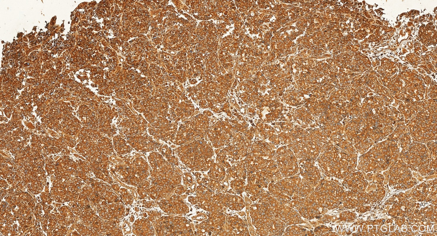IHC staining of human stomach cancer using 87952-1-RR Immunohistochemistry (IHC) staining of human stomach cancer tissue using VPS34 Recombinant monoclonal antibody (87952-1-RR)
