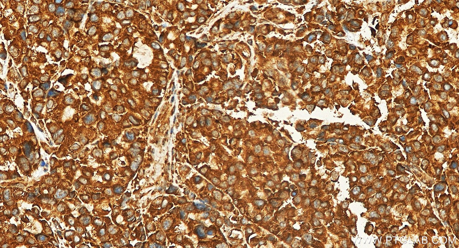 IHC staining of human stomach cancer using 87952-1-RR Immunohistochemistry (IHC) staining of human stomach cancer tissue using VPS34 Recombinant monoclonal antibody (87952-1-RR)