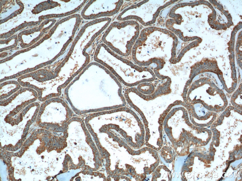 Immunohistochemistry (IHC) staining of human ovary tumor tissue using VPS37A Monoclonal antibody (66327-1-Ig)