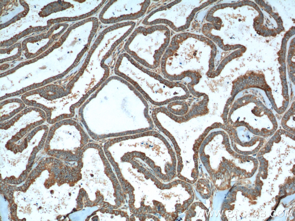 IHC staining of human ovary tumor using 66327-1-Ig