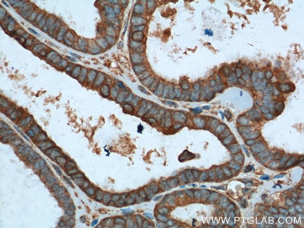 Immunohistochemistry (IHC) staining of human ovary tumor tissue using VPS37A Monoclonal antibody (66327-1-Ig)