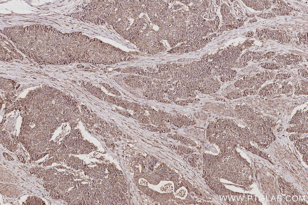 Immunohistochemistry (IHC) staining of human stomach cancer tissue using VPS4A Polyclonal antibody (14272-1-AP)