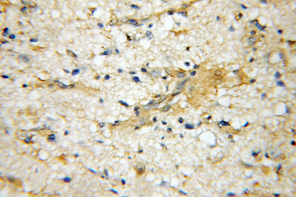 Immunohistochemistry (IHC) staining of human gliomas tissue using VPS52 Polyclonal antibody (11662-2-AP)