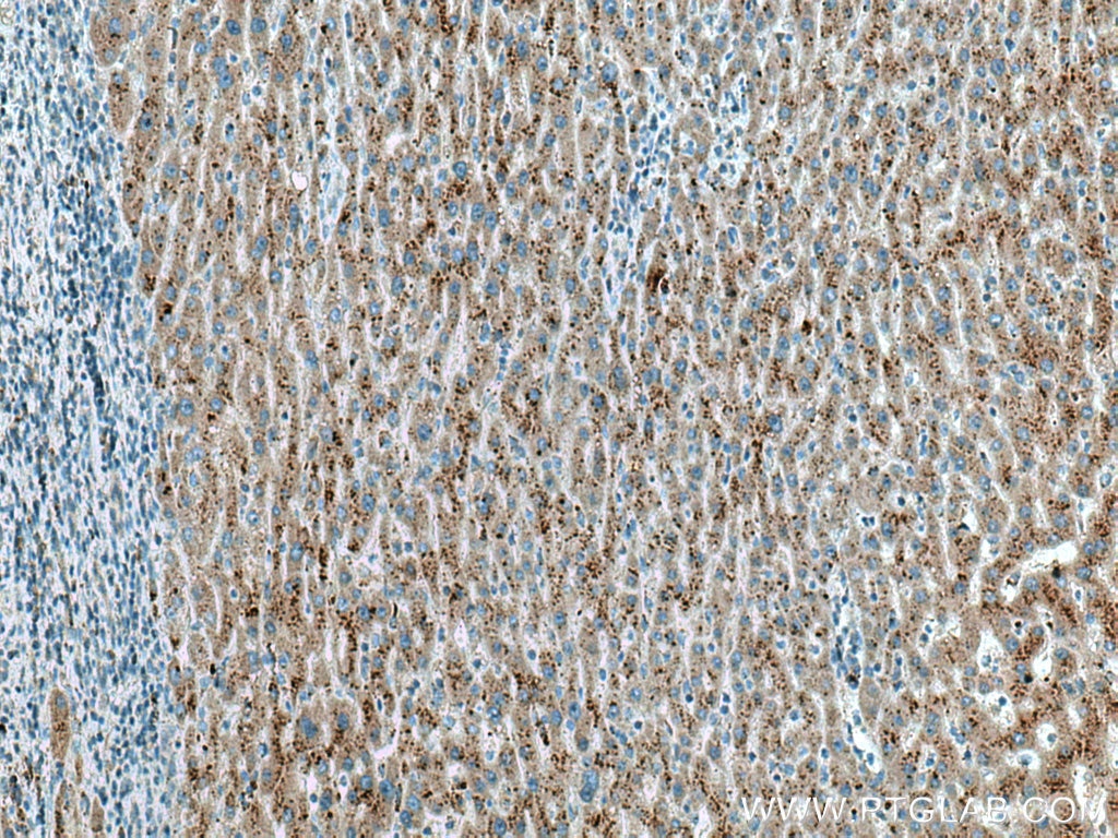 Immunohistochemistry (IHC) staining of human liver cancer tissue using VPS54 Monoclonal antibody (67404-1-Ig)