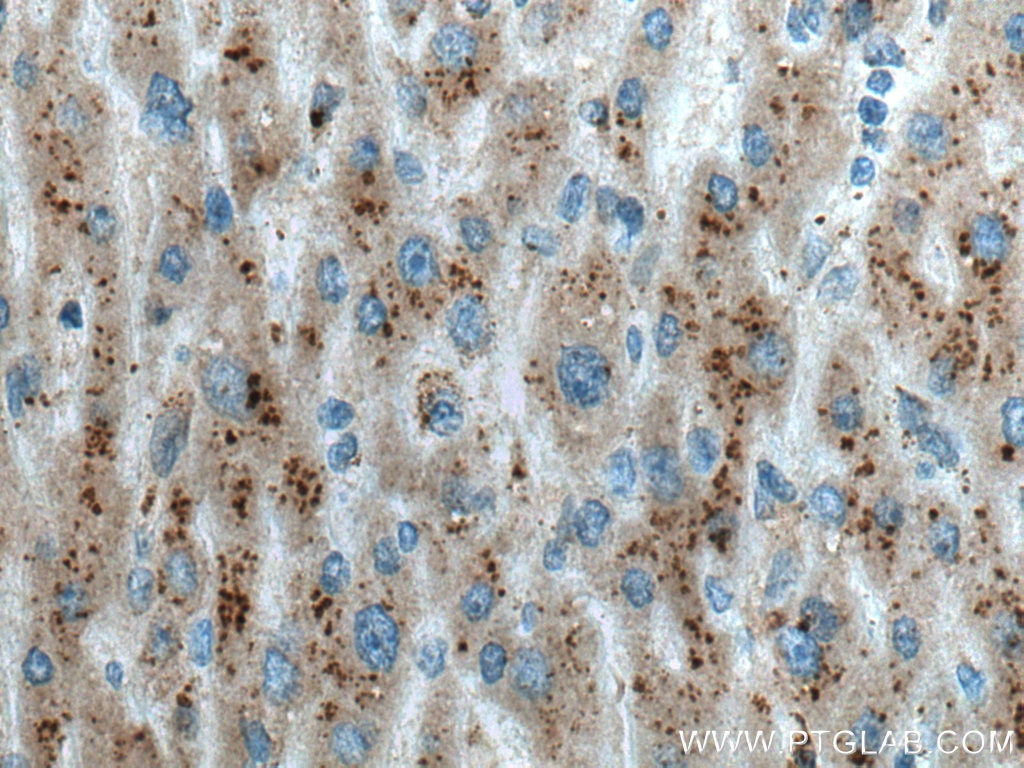 Immunohistochemistry (IHC) staining of human liver cancer tissue using VPS54 Monoclonal antibody (67404-1-Ig)