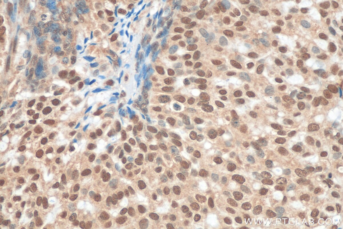 Immunohistochemistry (IHC) staining of human breast hyperplasia tissue using VPS72 Polyclonal antibody (15143-1-AP)