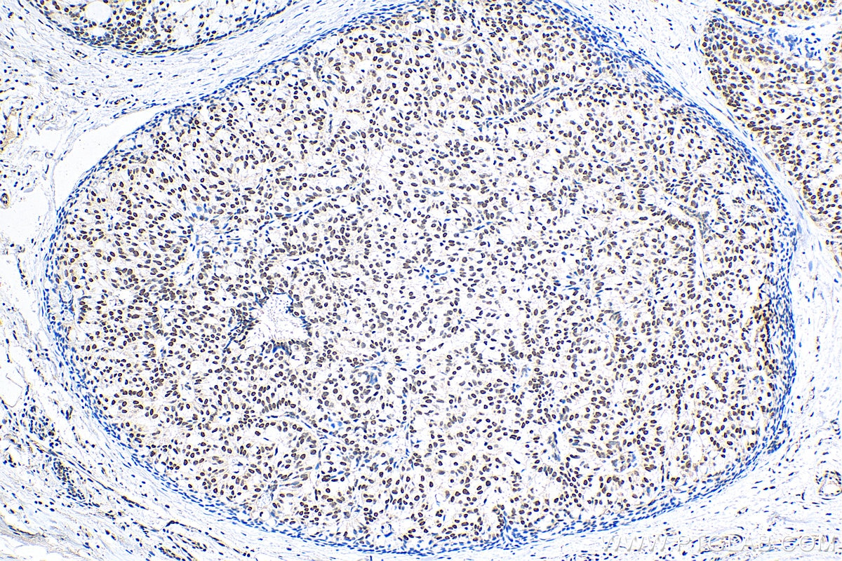 Immunohistochemistry (IHC) staining of human breast hyperplasia tissue using VPS72 Polyclonal antibody (15143-1-AP)