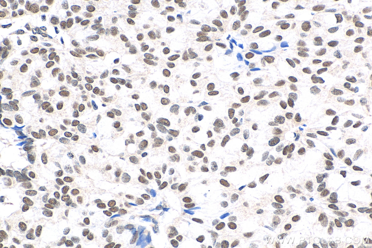 Immunohistochemistry (IHC) staining of human breast hyperplasia tissue using VPS72 Polyclonal antibody (15143-1-AP)