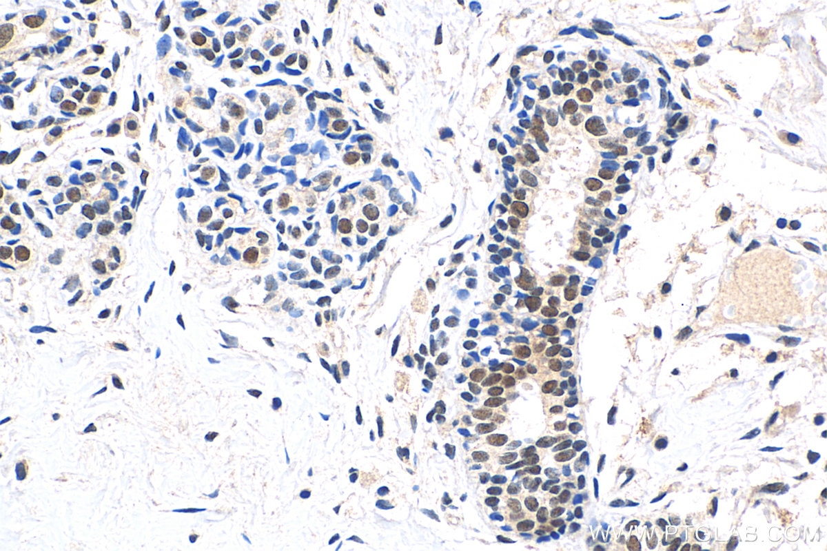 Immunohistochemistry (IHC) staining of human breast hyperplasia tissue using VPS72 Polyclonal antibody (15143-1-AP)